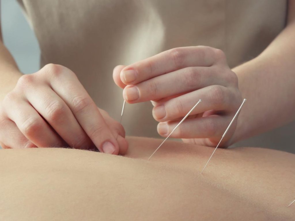 Essential Information about  Acupuncture Therapy